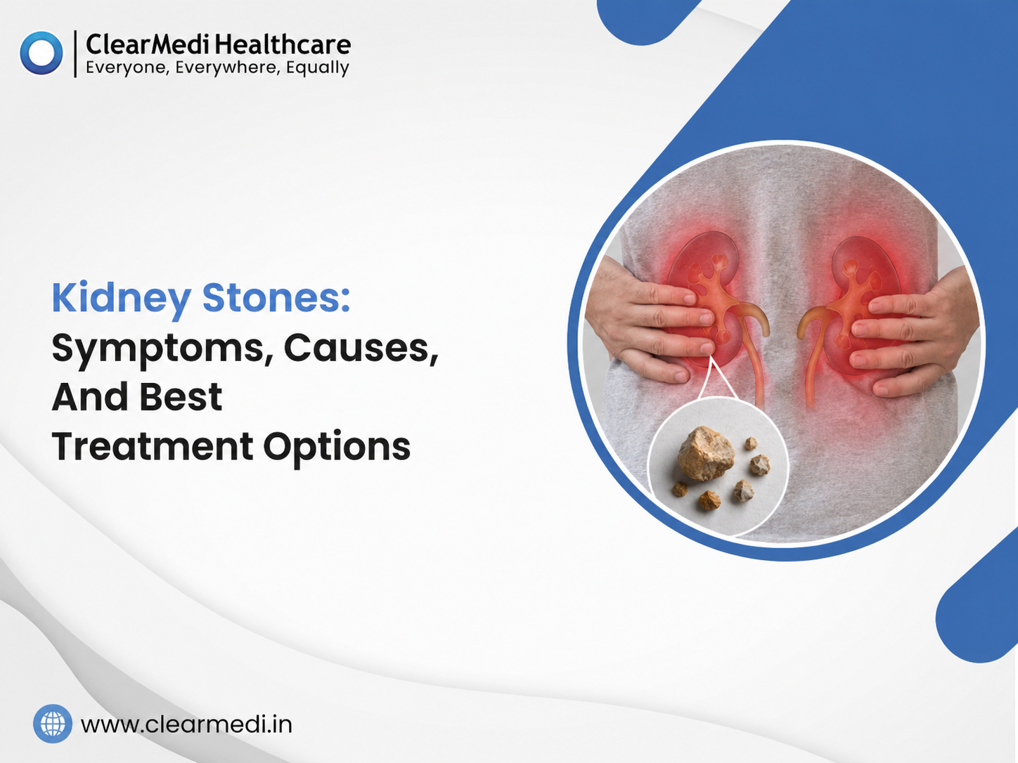 Kidney Stones: Symptoms, Causes, And Best Treatment Options