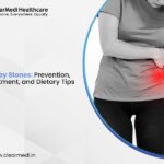 Kidney Stones: Prevention, Treatment, and Dietary Tips